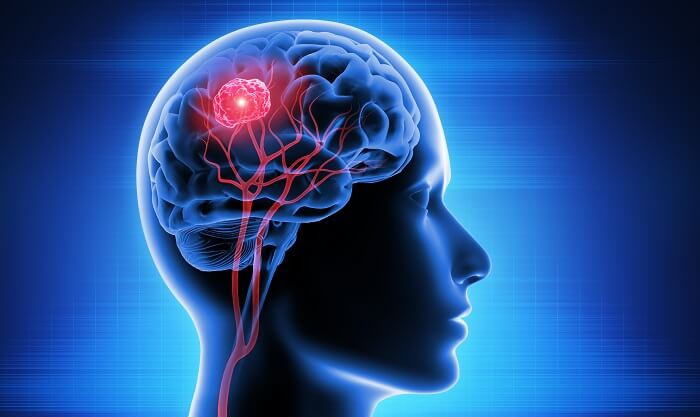 IA mostra-se promissora no tratamento de câncer cerebral